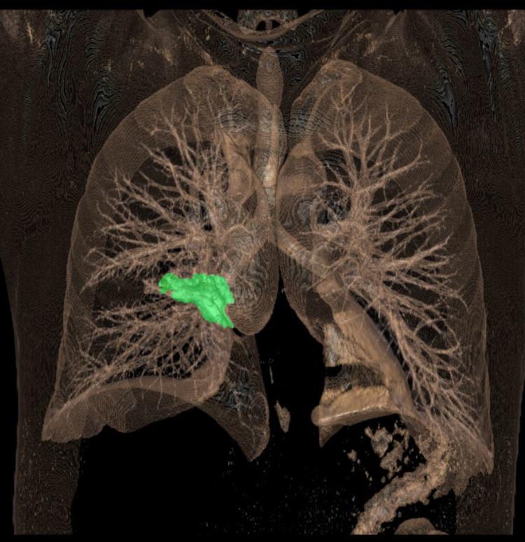 Lung tumor after photo