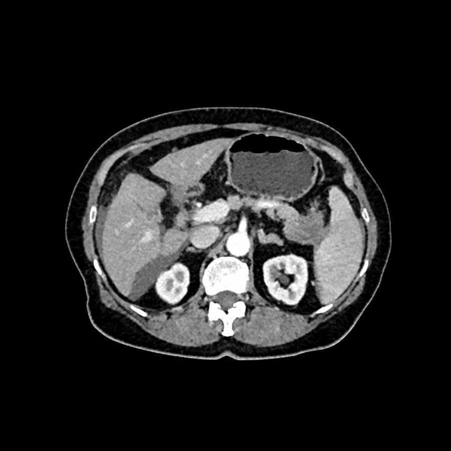 Pancreatic tumor before photo