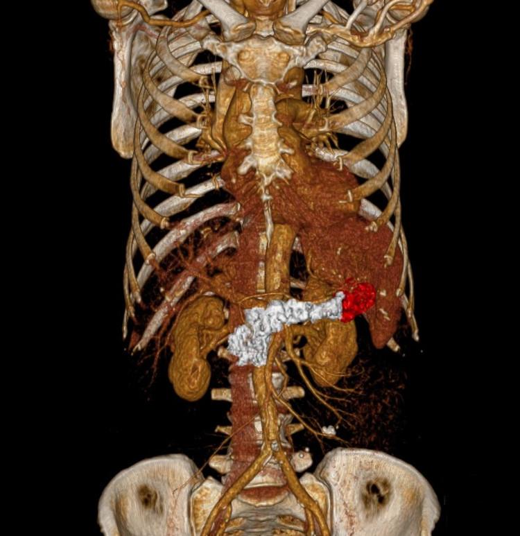 Pancreatic tumor after photo