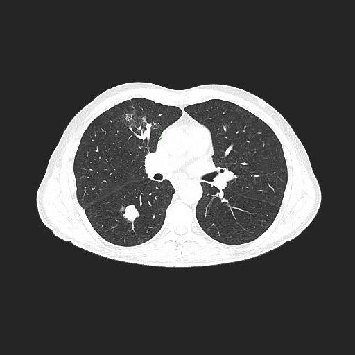 Guz płuca before photo